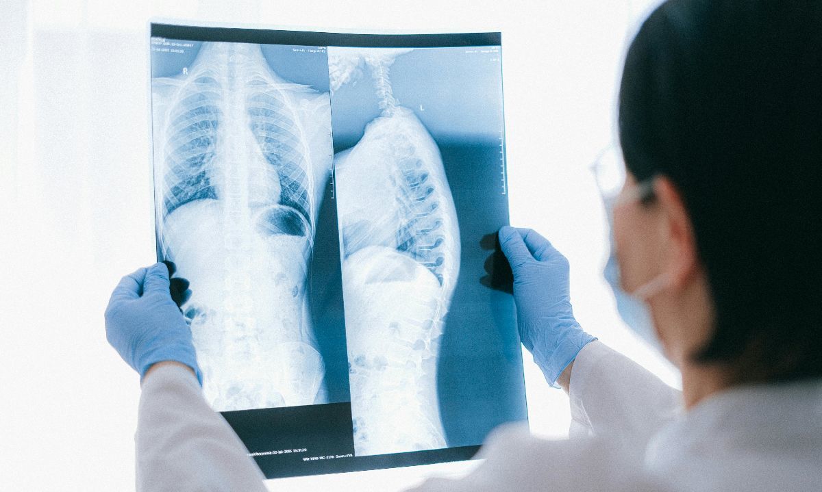 Aumento de casos de tuberculosis en Chile: expertos advierten sobre causas y riesgos